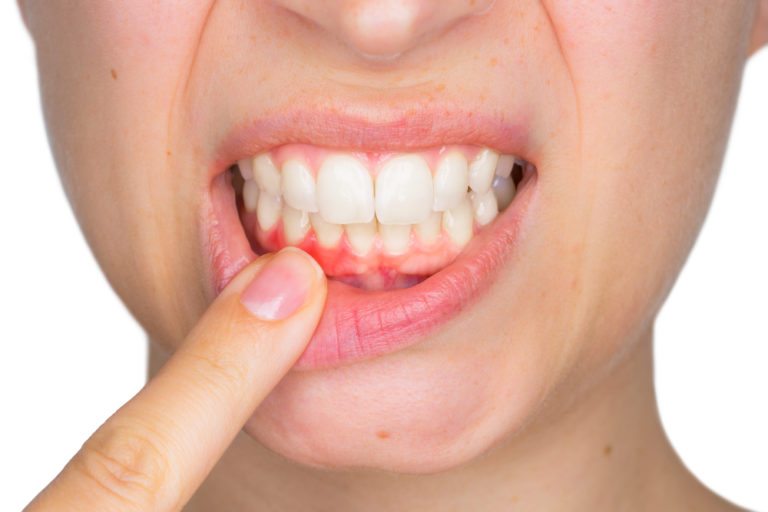 My gums around one tooth are swollen – what could it be? - Stonebridge